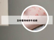 怎样看待城市牛皮癣