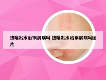 拔罐出水治银屑病吗 拔罐出水治银屑病吗图片