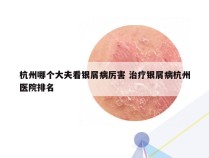 杭州哪个大夫看银屑病厉害 治疗银屑病杭州医院排名