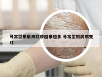 寻常型银屑病红疹越来越多 寻常型银屑病变红