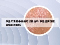 不是天生的牛皮癣可以根治吗 不是遗传性银屑病能治好吗