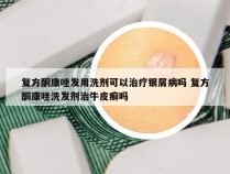 复方酮康唑发用洗剂可以治疗银屑病吗 复方酮康唑洗发剂治牛皮癣吗