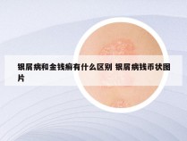 银屑病和金钱癣有什么区别 银屑病钱币状图片