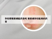 孕妇得银屑病能药膏吗 银屑病孕妇能用的药膏