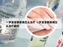 一岁宝宝银屑病怎么治疗 一岁宝宝银屑病怎么治疗最好