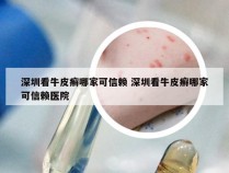 深圳看牛皮癣哪家可信赖 深圳看牛皮癣哪家可信赖医院