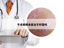 牛皮癣根本就治不好是吗