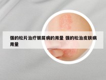 强的松片治疗银屑病的用量 强的松治皮肤病用量