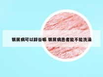 银屑病可以辟谷嘛 银屑病患者能不能洗澡