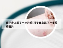 孩子身上起了一小片癣 孩子身上起了一小片癣图片