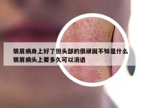 银屑病身上好了但头部的很顽固不知是什么 银屑病头上要多久可以消退