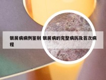 银屑病病例鉴别 银屑病的完整病历及首次病程