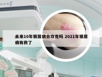 未来10年银屑病会攻克吗 2021年银屑病有救了
