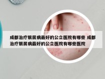 成都治疗银屑病最好的公立医院有哪些 成都治疗银屑病最好的公立医院有哪些医院