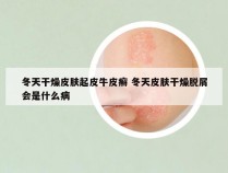 冬天干燥皮肤起皮牛皮癣 冬天皮肤干燥脱屑会是什么病