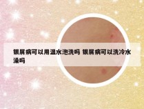 银屑病可以用温水泡洗吗 银屑病可以洗冷水澡吗