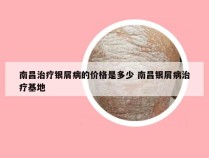 南昌治疗银屑病的价格是多少 南昌银屑病治疗基地