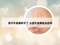 孩子牛皮癣好不了 小孩牛皮癣能治愈吗