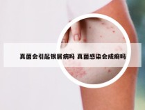 真菌会引起银屑病吗 真菌感染会成癣吗