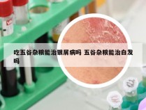 吃五谷杂粮能治银屑病吗 五谷杂粮能治白发吗