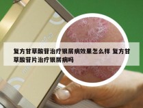 复方甘草酸苷治疗银屑病效果怎么样 复方甘草酸苷片治疗银屑病吗