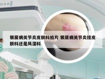 银屑病关节炎皮肤科拍片 银屑病关节炎挂皮肤科还是风湿科