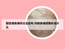 假性银屑病可以治愈吗 伪银屑病初期长成什么