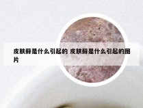 皮肤藓是什么引起的 皮肤藓是什么引起的图片
