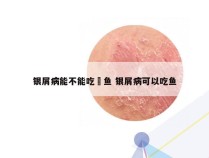 银屑病能不能吃鮰鱼 银屑病可以吃鱼