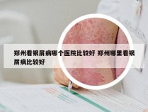 郑州看银屑病哪个医院比较好 郑州哪里看银屑病比较好