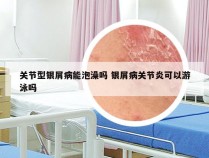 关节型银屑病能泡澡吗 银屑病关节炎可以游泳吗