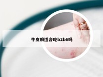 牛皮癣适合吃b2b6吗