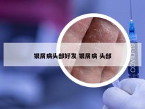 银屑病头部好发 银屑病 头部