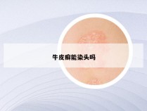 牛皮癣能染头吗
