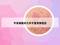 牛皮癣最长几年不复发算痊愈