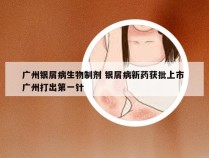 广州银屑病生物制剂 银屑病新药获批上市 广州打出第一针
