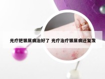 光疗把银屑病治好了 光疗治疗银屑病还复发