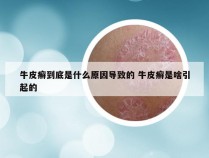 牛皮癣到底是什么原因导致的 牛皮癣是啥引起的