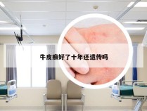 牛皮癣好了十年还遗传吗