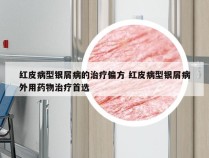红皮病型银屑病的治疗偏方 红皮病型银屑病外用药物治疗首选