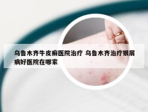 乌鲁木齐牛皮癣医院治疗 乌鲁木齐治疗银屑病好医院在哪家