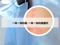 一块一块的藓 一块一块的癣图片