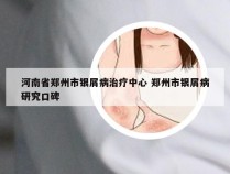 河南省郑州市银屑病治疗中心 郑州市银屑病研究口碑