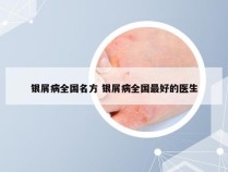 银屑病全国名方 银屑病全国最好的医生