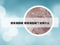 银屑病戳破 银屑病抠破了涂抹什么