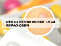 儿童头皮上寻常型银屑病如何治疗 儿童头皮银屑病头发能恢复吗