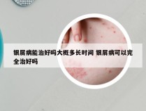 银屑病能治好吗大概多长时间 银屑病可以完全治好吗