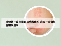 感冒就一定能让银屑病发病吗 感冒一定会加重银屑病吗
