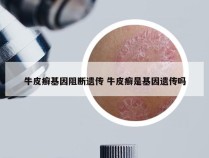 牛皮癣基因阻断遗传 牛皮癣是基因遗传吗