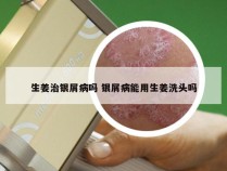 生姜治银屑病吗 银屑病能用生姜洗头吗